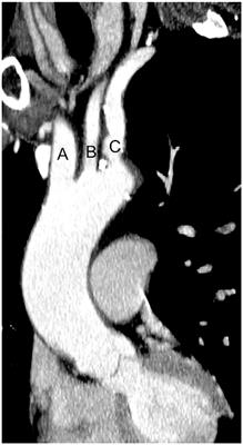 The Role of Cerebral Embolic Protection Devices During Transcatheter Aortic Valve Replacement